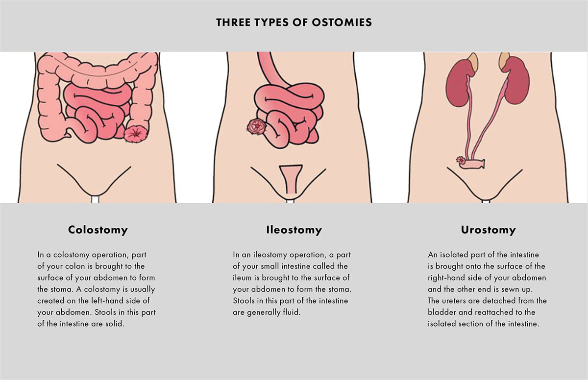 What is a stoma, Types of Stoma